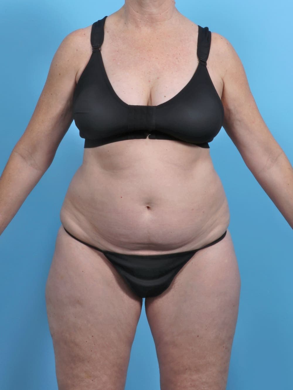 Liposuction case #5634 before, image 1