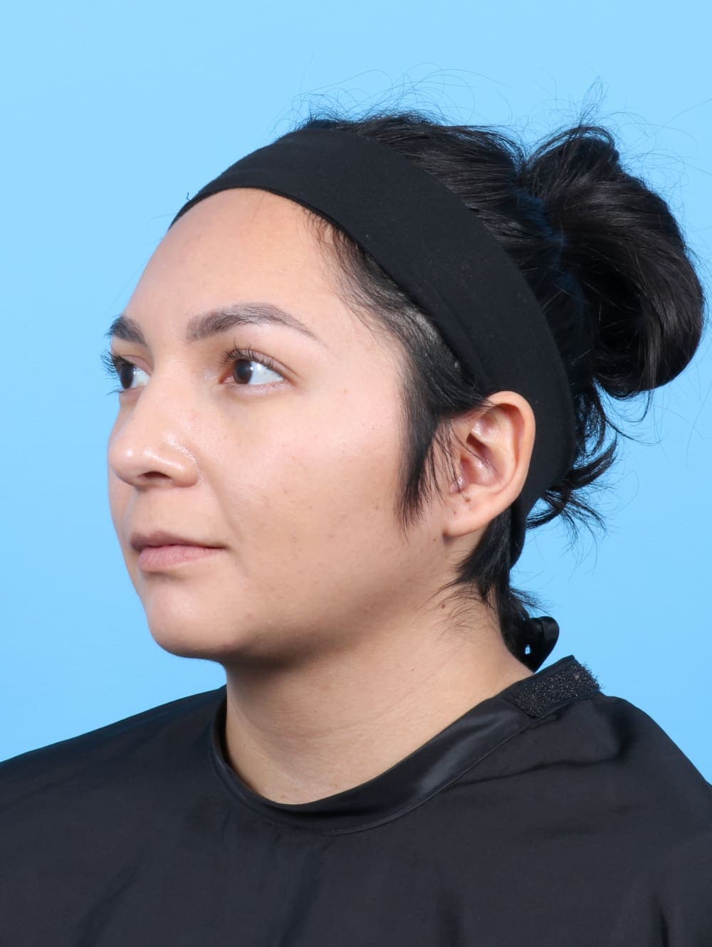 Rhinoplasty case #6531 after, image 3