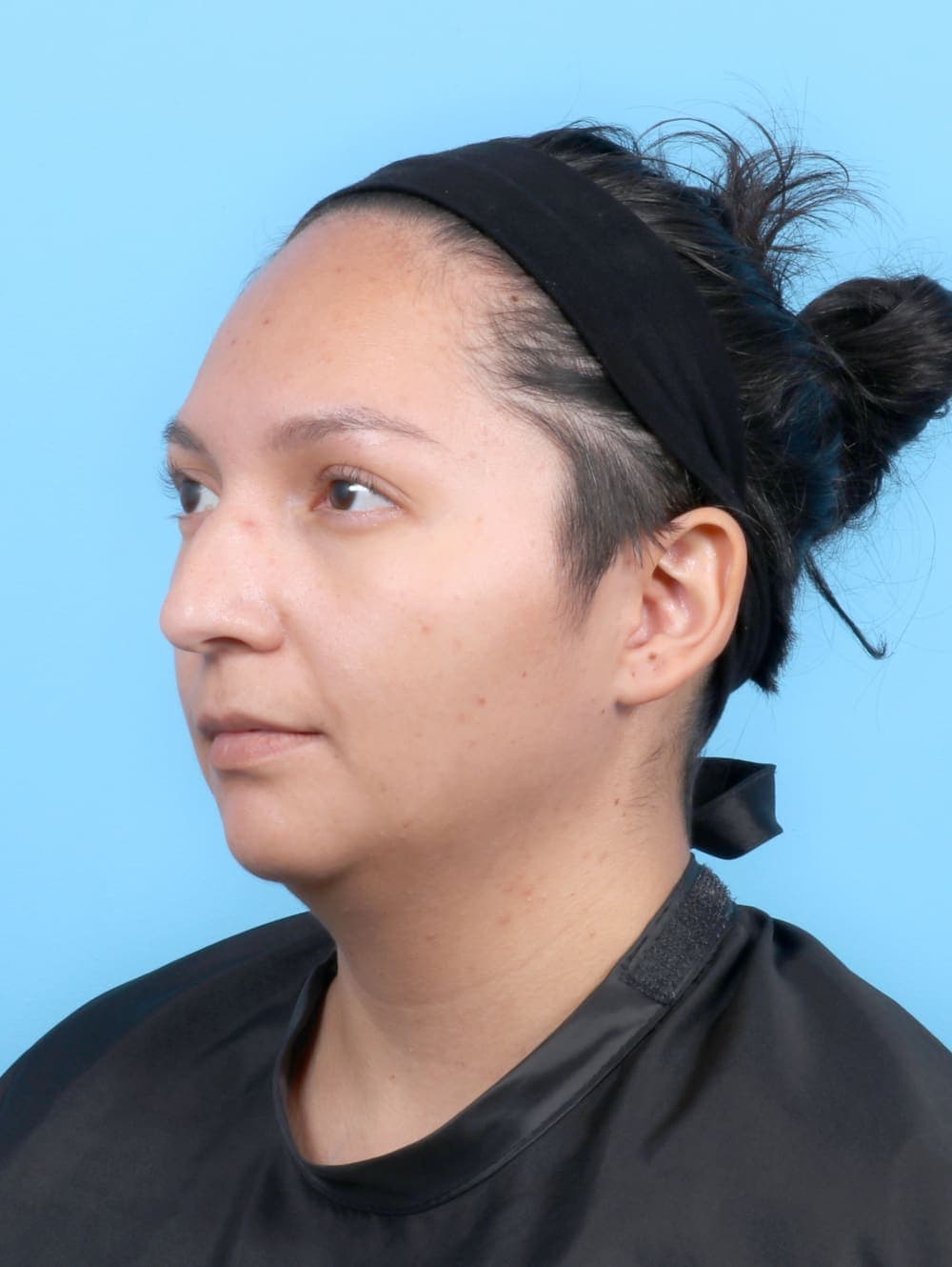 Rhinoplasty case #6531 before, image 3