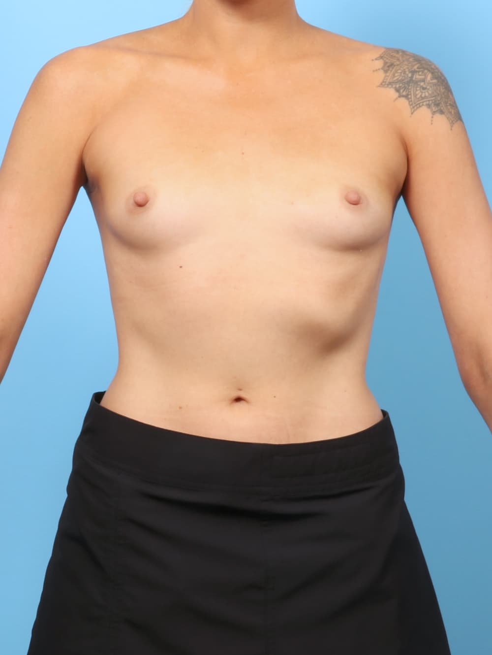 Breast Augmentation case #9005 before, image 1
