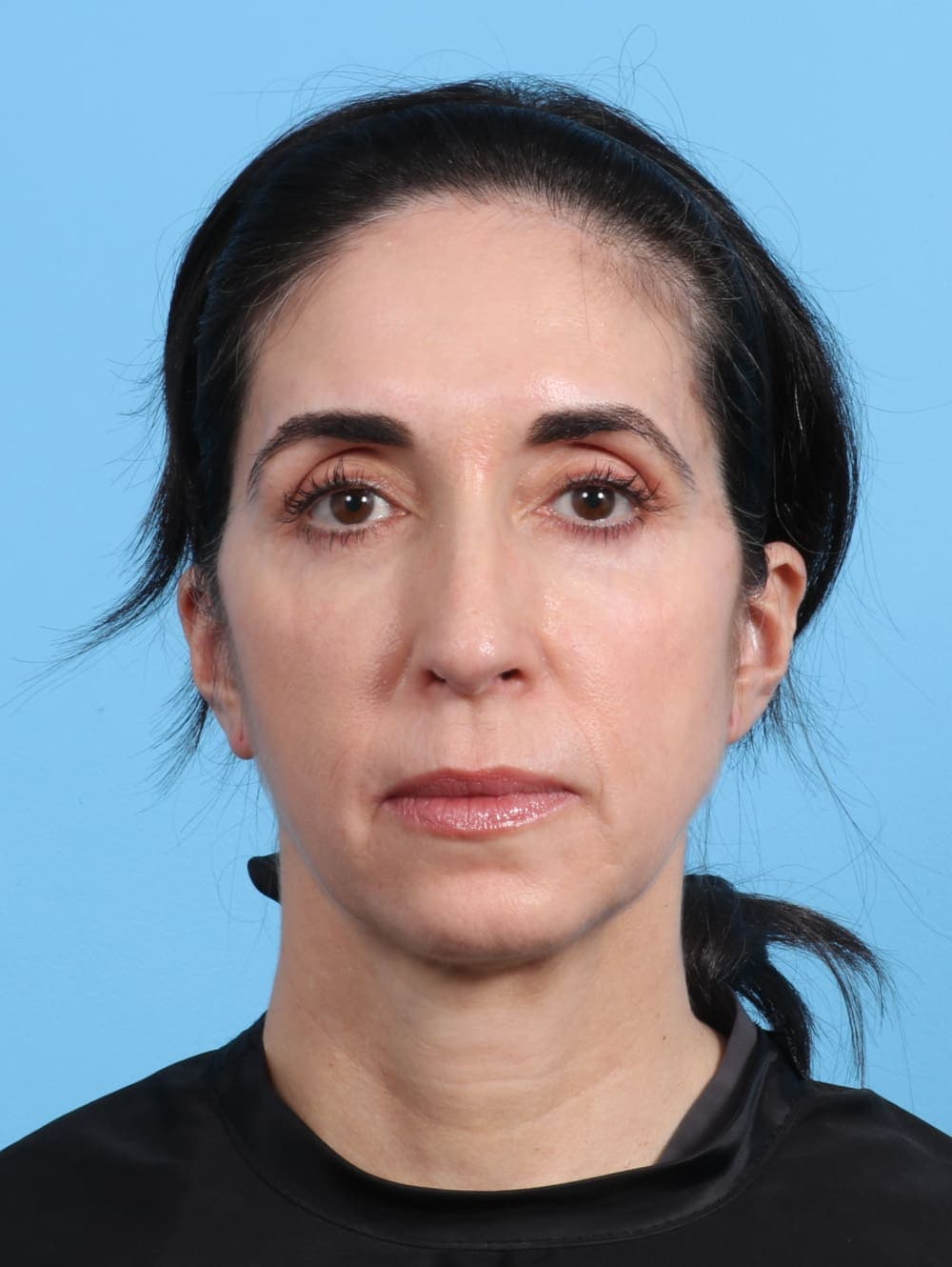 Eyelid Surgery case #2963 after, image 1