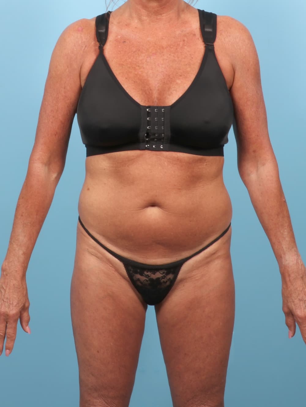 Tummy Tuck case #9010 before, image 1