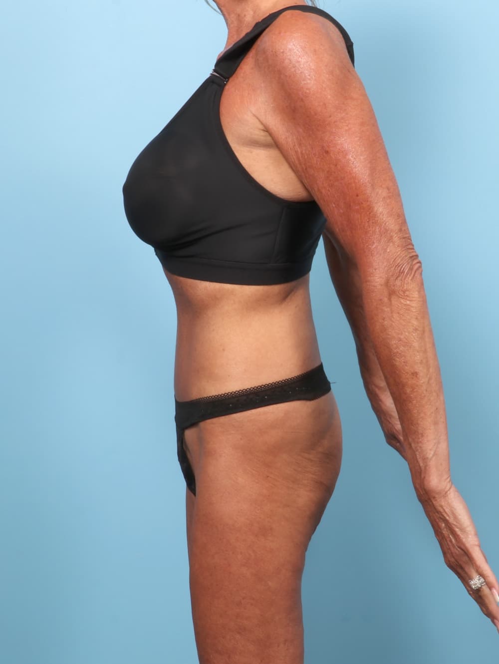 Tummy Tuck case #9010 after, image 3