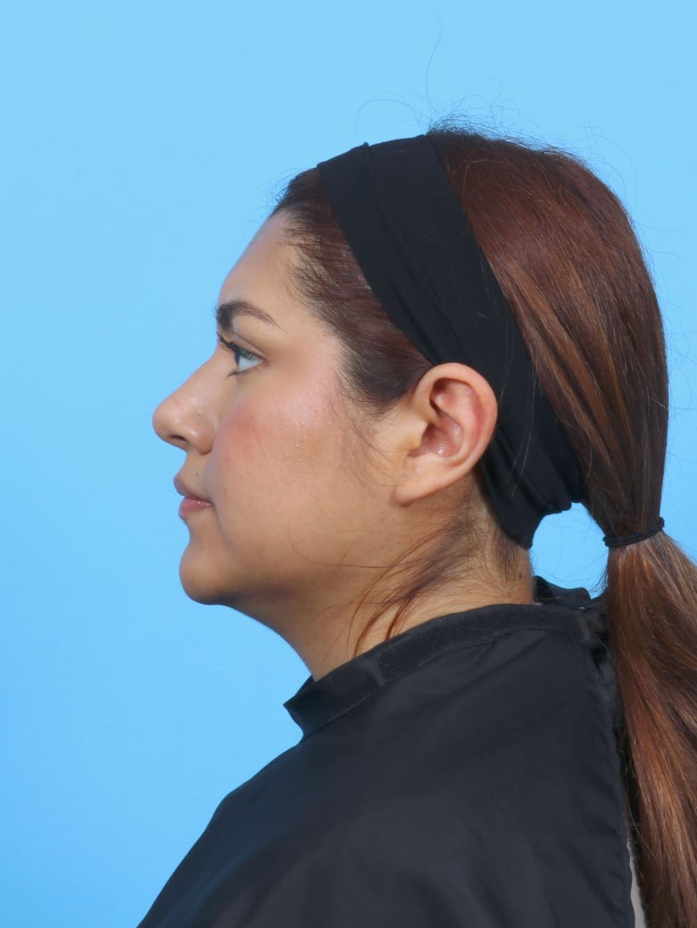 Rhinoplasty case #6066 after, image 1