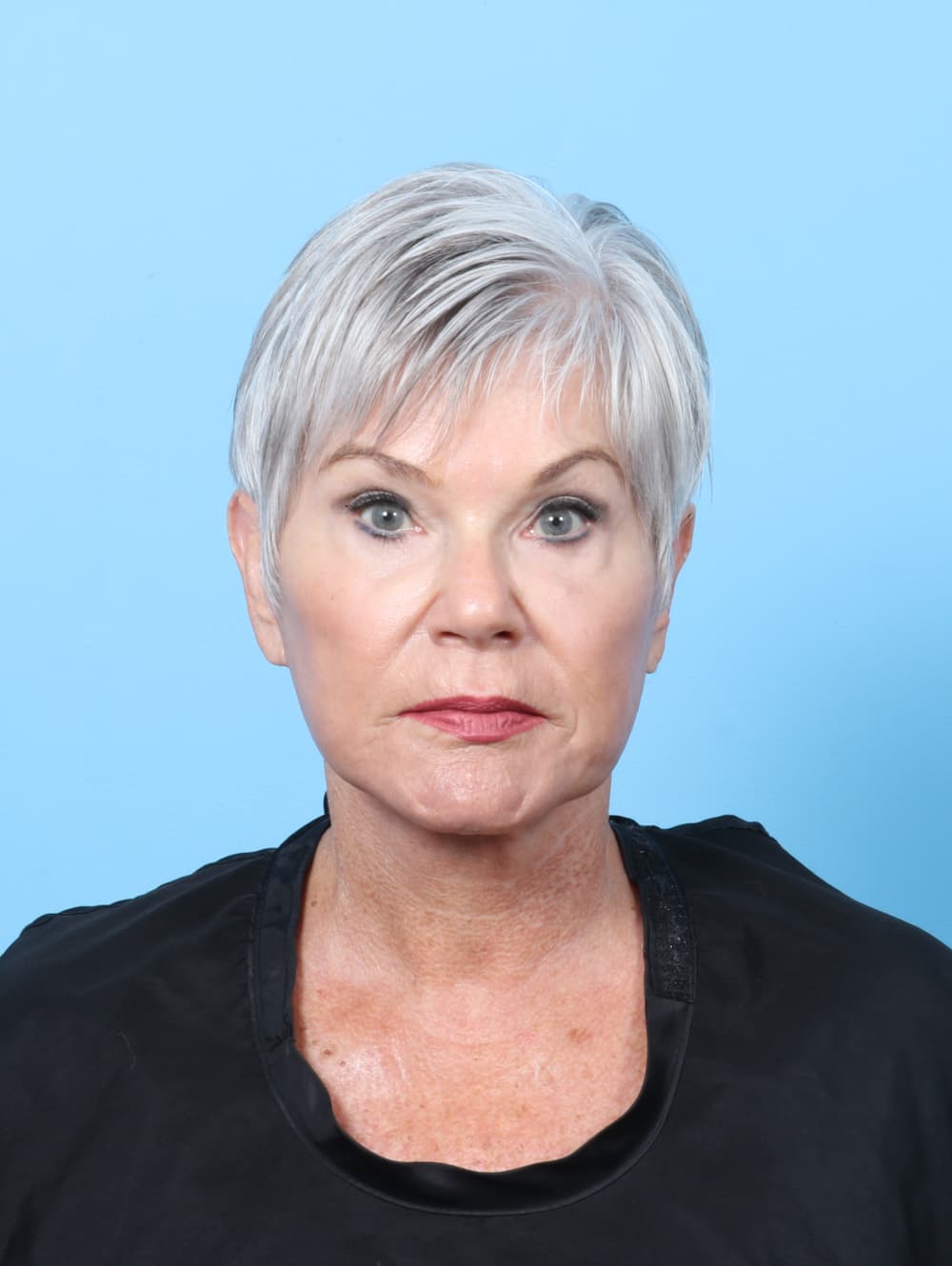 Facelift case #8306 after