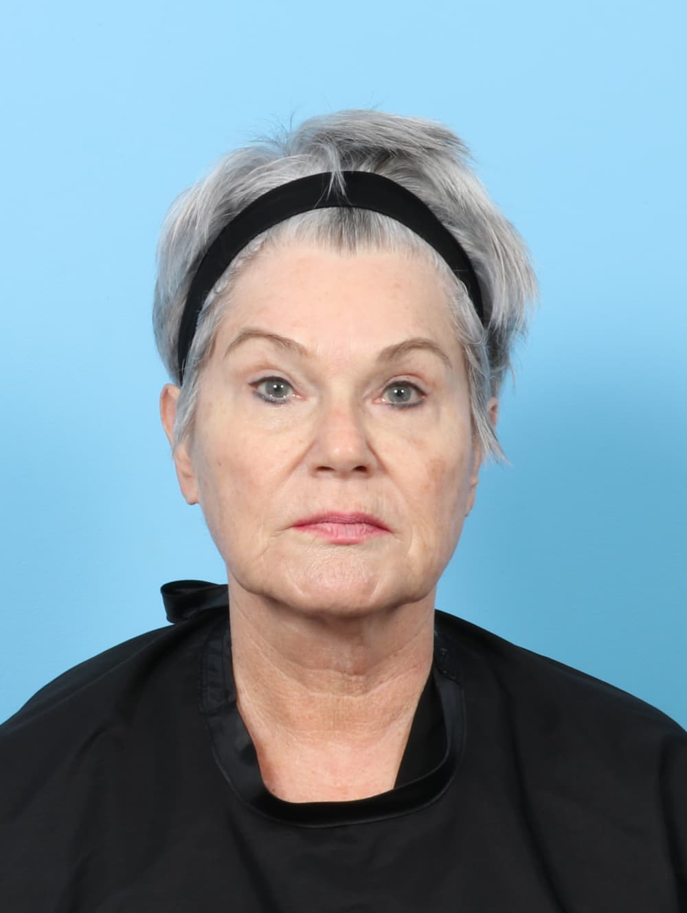Facelift case #8306 before