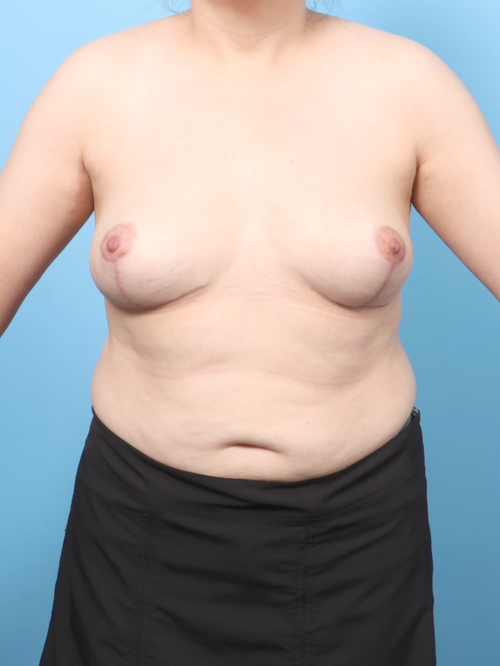 Breast Implant Removal with Lift case #8814 after