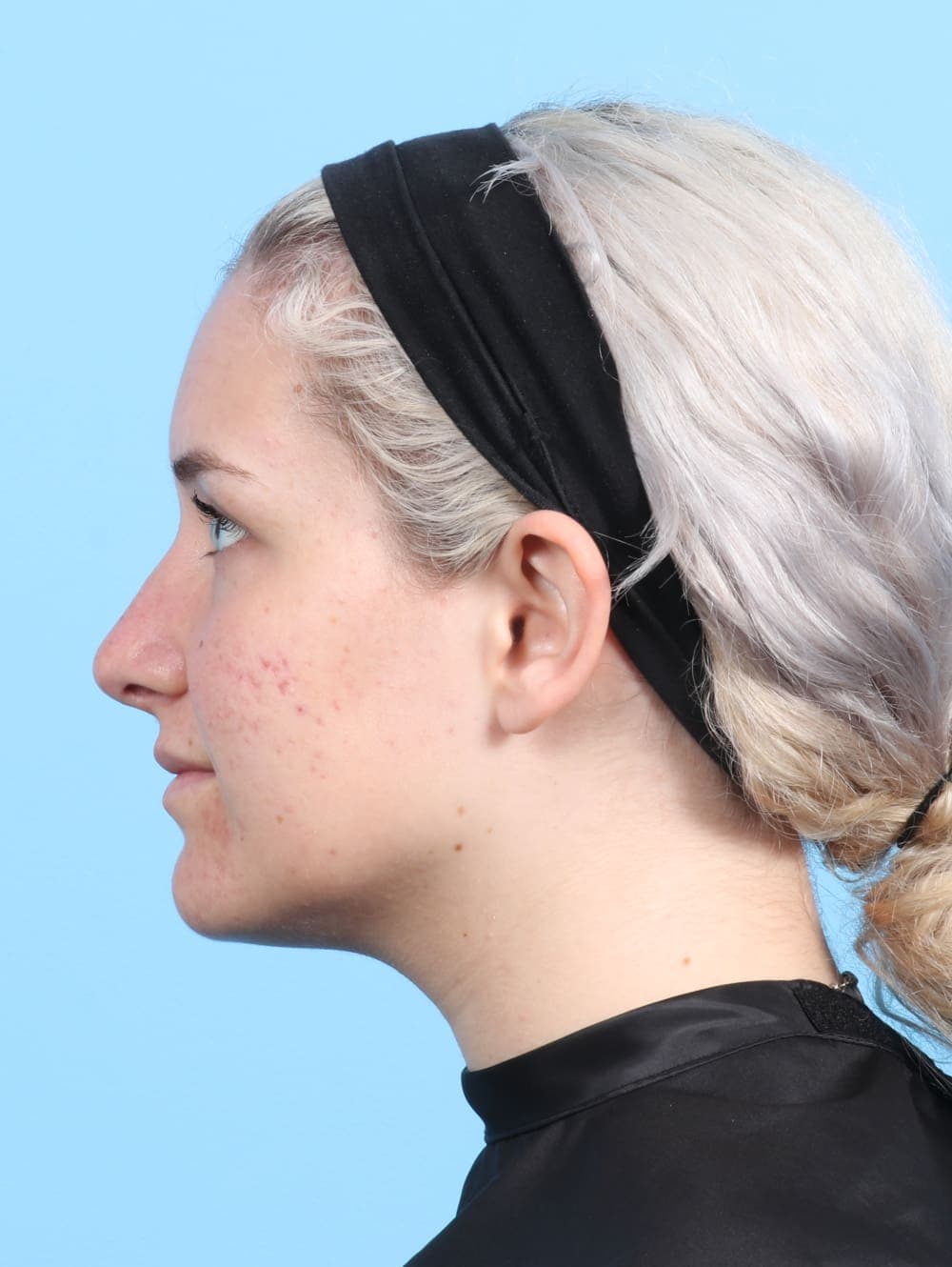 Rhinoplasty case #2585 after, image 1