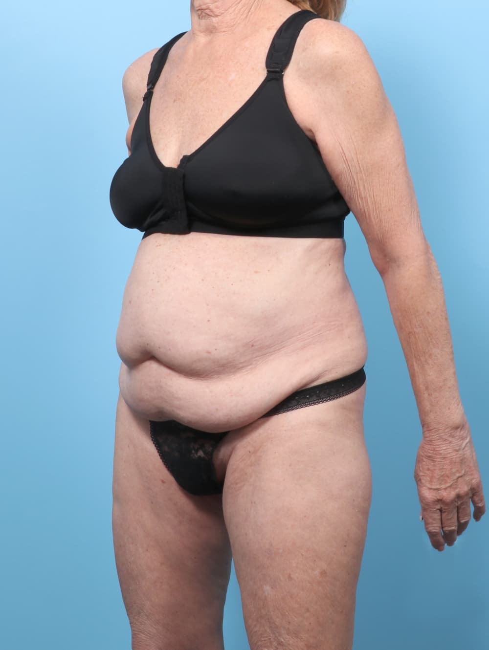 Tummy Tuck case #9013 before, image 2