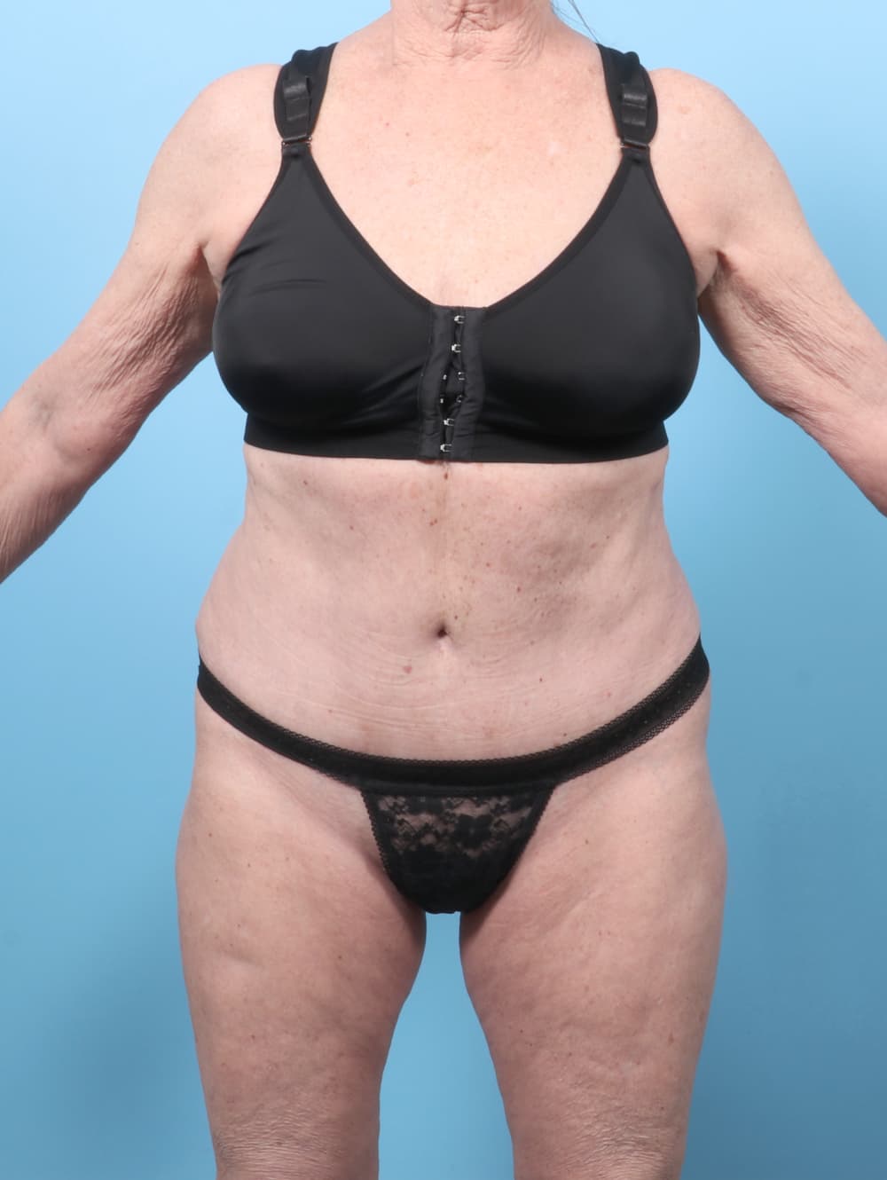 Tummy Tuck case #9013 after, image 1