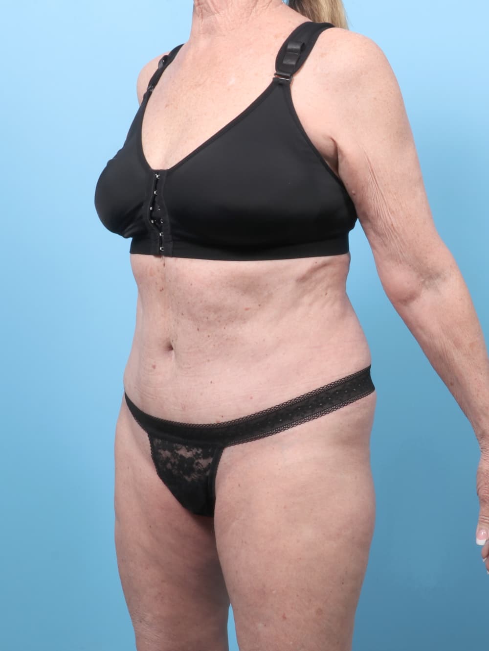 Tummy Tuck case #9013 after, image 2