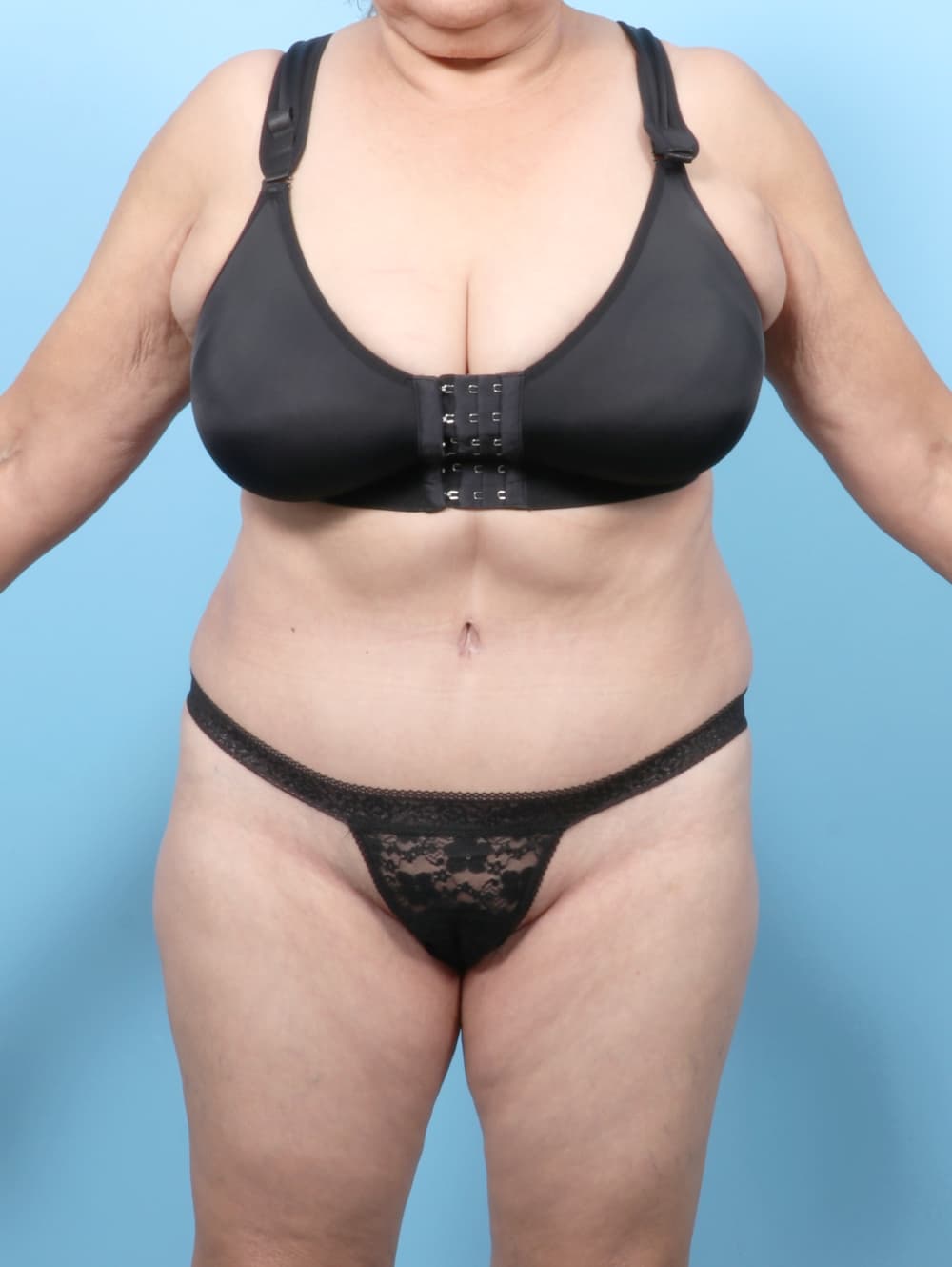Tummy Tuck case #7501 after, image 1