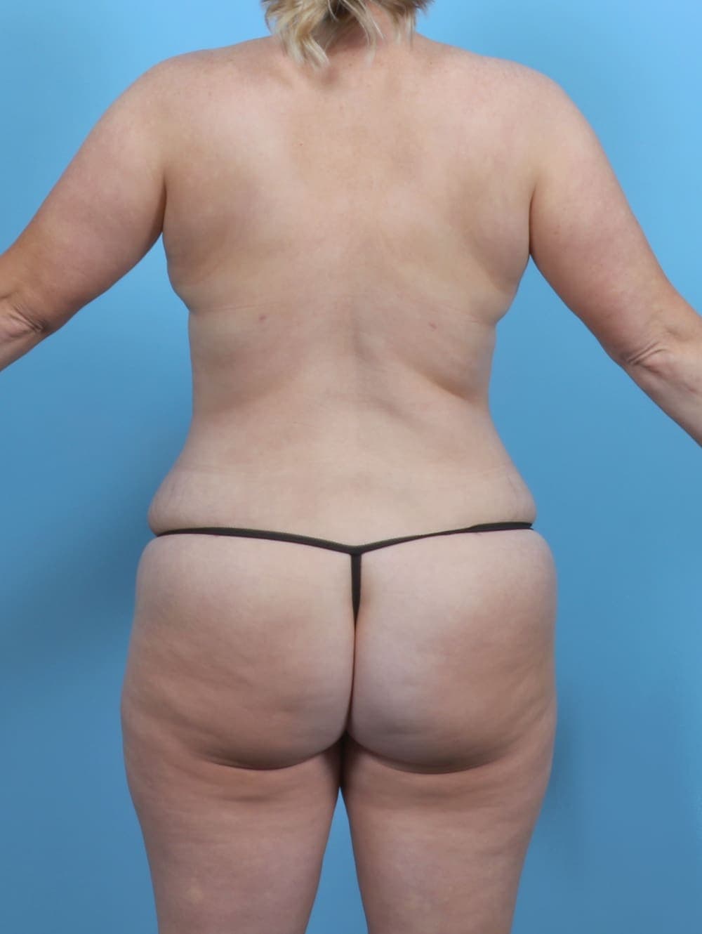 Liposuction case #5092 after, image 4