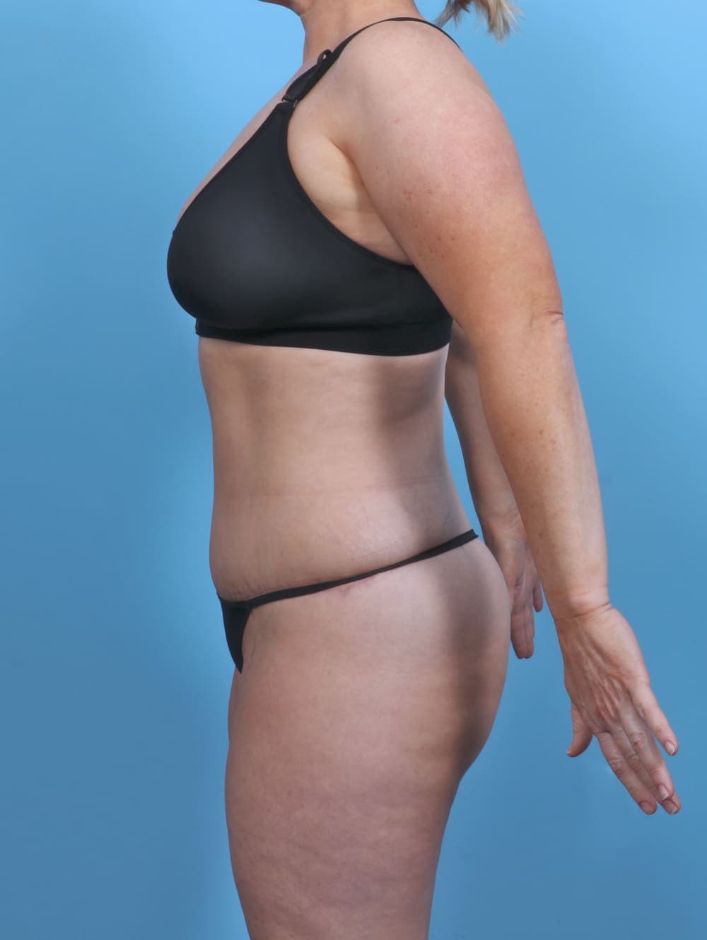 Liposuction case #5092 after, image 3