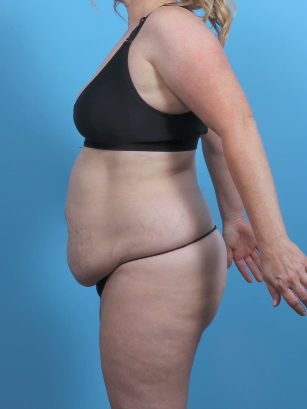 Liposuction case #5092 before, image 3