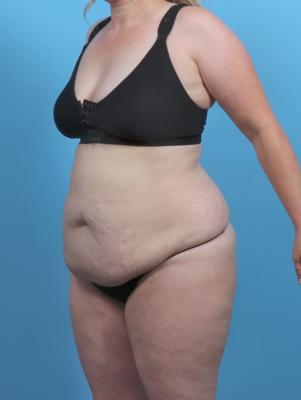 Liposuction case #5092 before, image 2