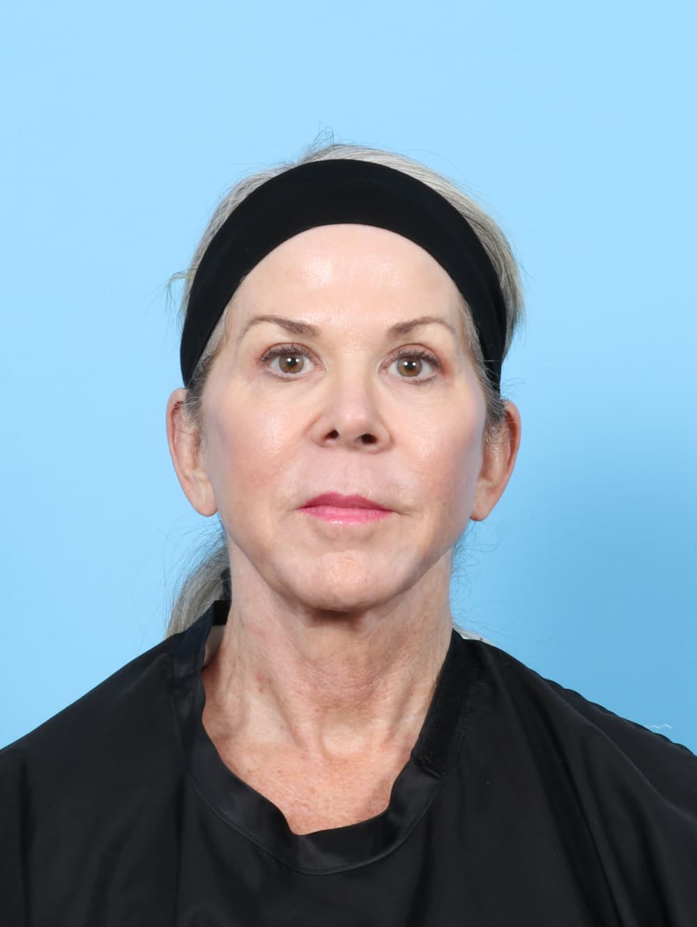 Eyelid Surgery case #7382 after
