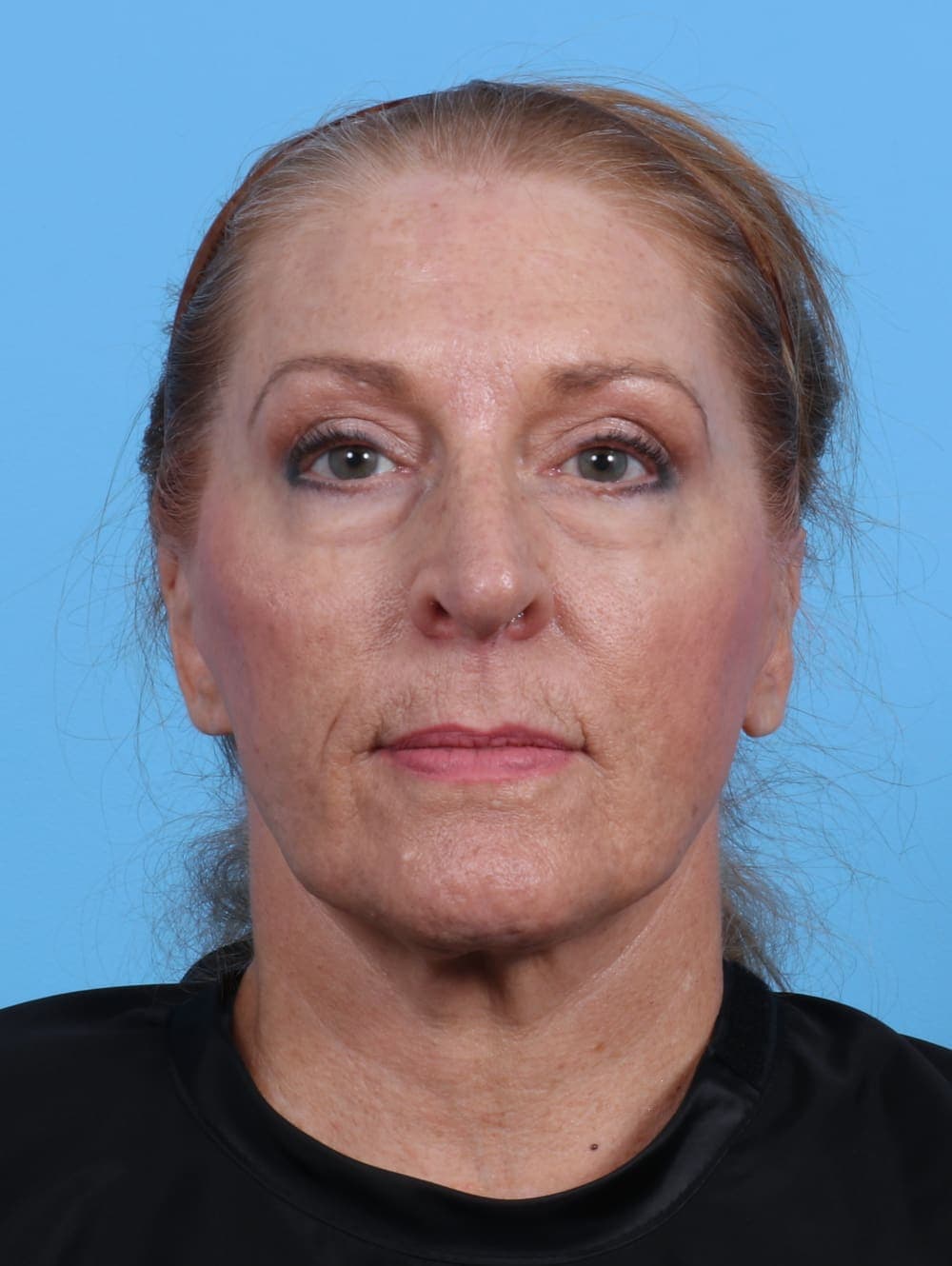Facelift case #3641 after