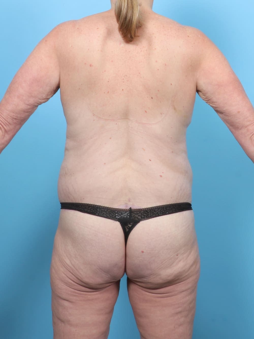 Breast Lift/Reduction case #6469 after, image 2