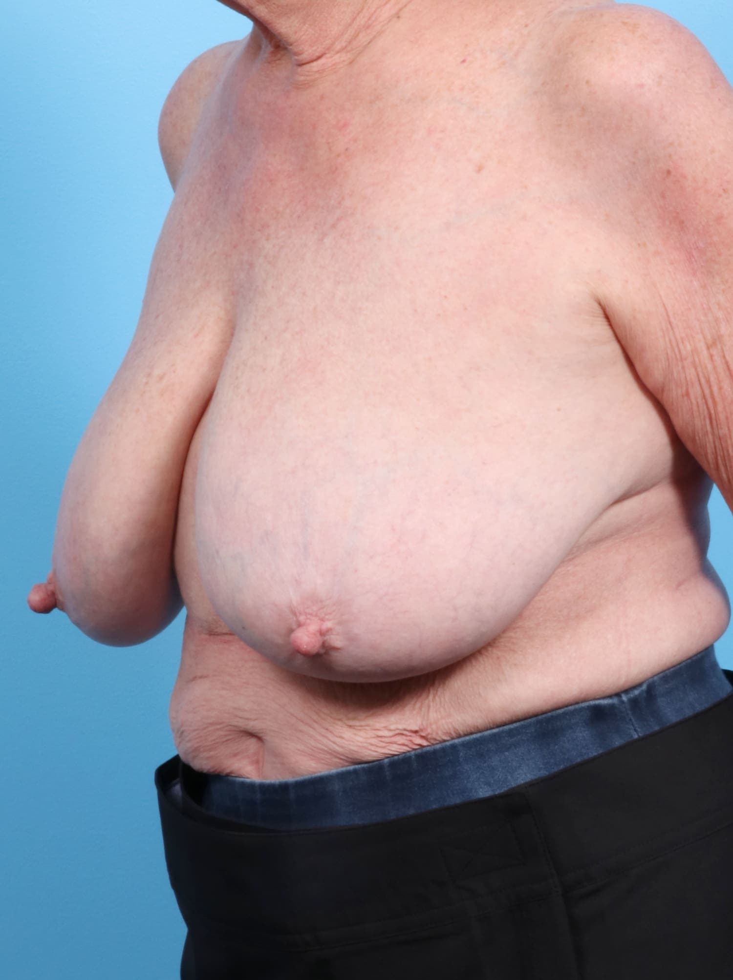 Breast Lift/Reduction case #1305 before, image 2