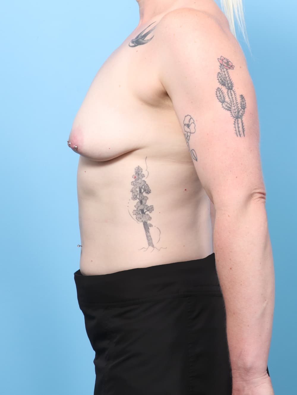 Breast Lift with Implants case #8990 before, image 3