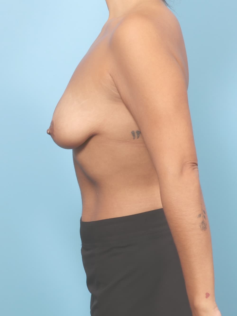 Breast Lift with Implants case #9035 before, image 3
