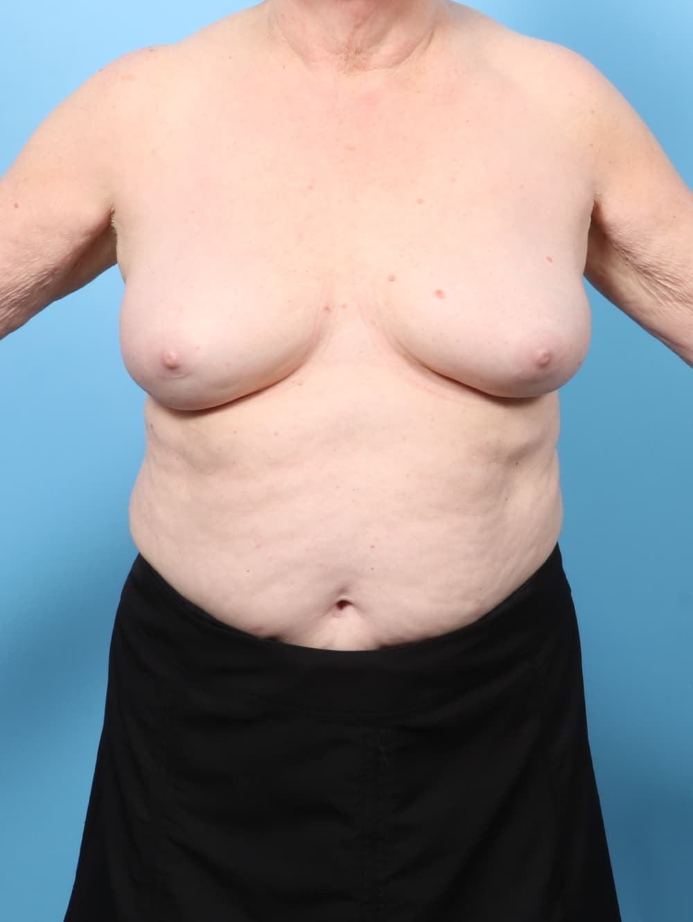 Breast Implant Revision case #8993 after, image 1