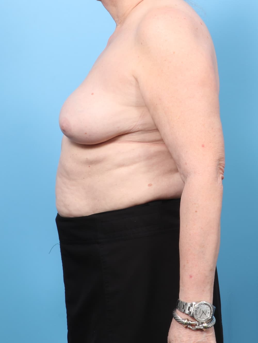 Breast Implant Revision case #8993 after, image 3