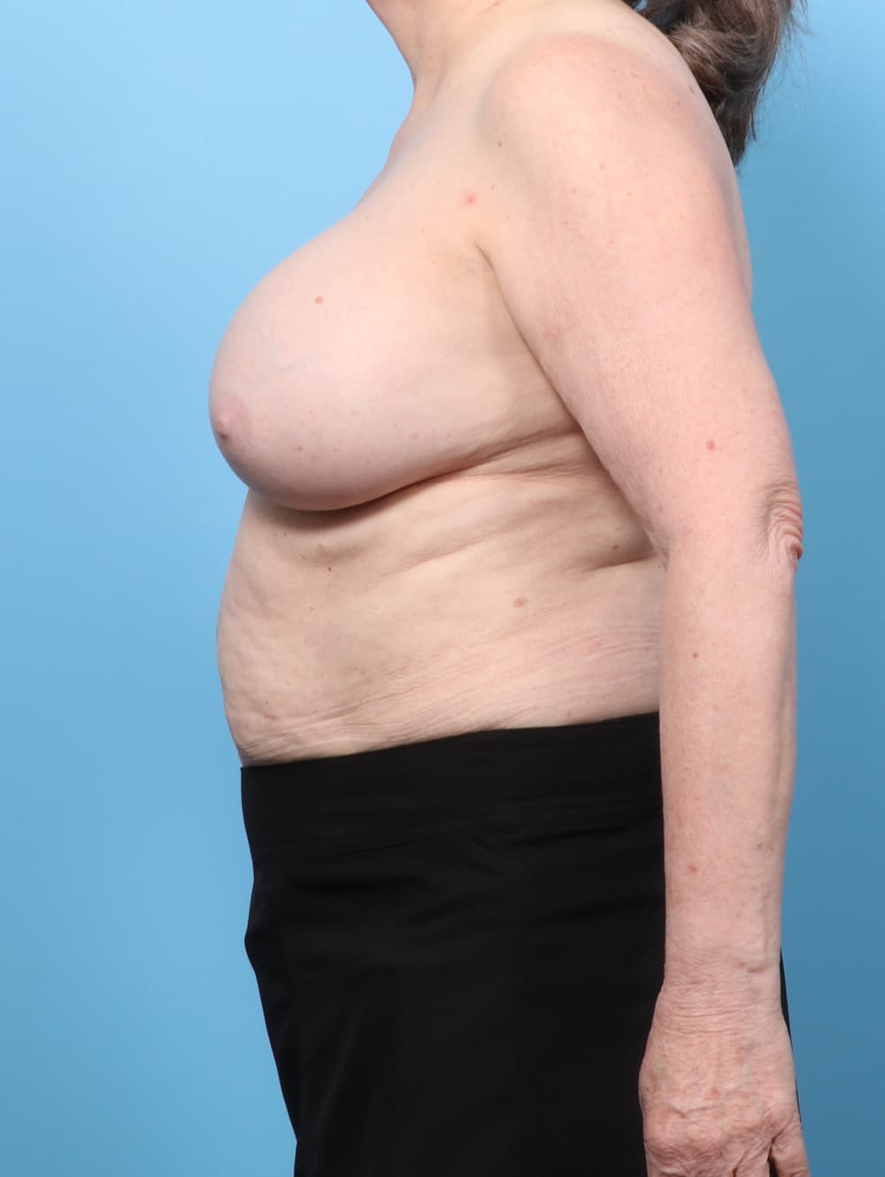 Breast Implant Revision case #8993 before, image 3