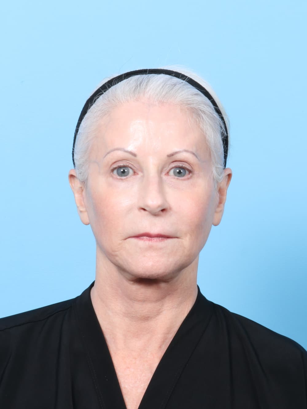 Facelift case #7863 after