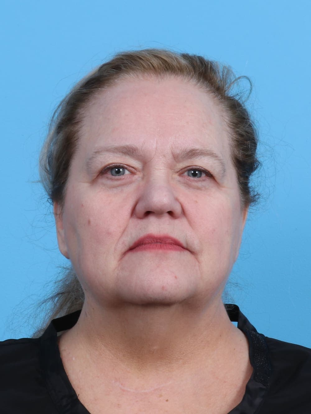 Facelift case #5668 before