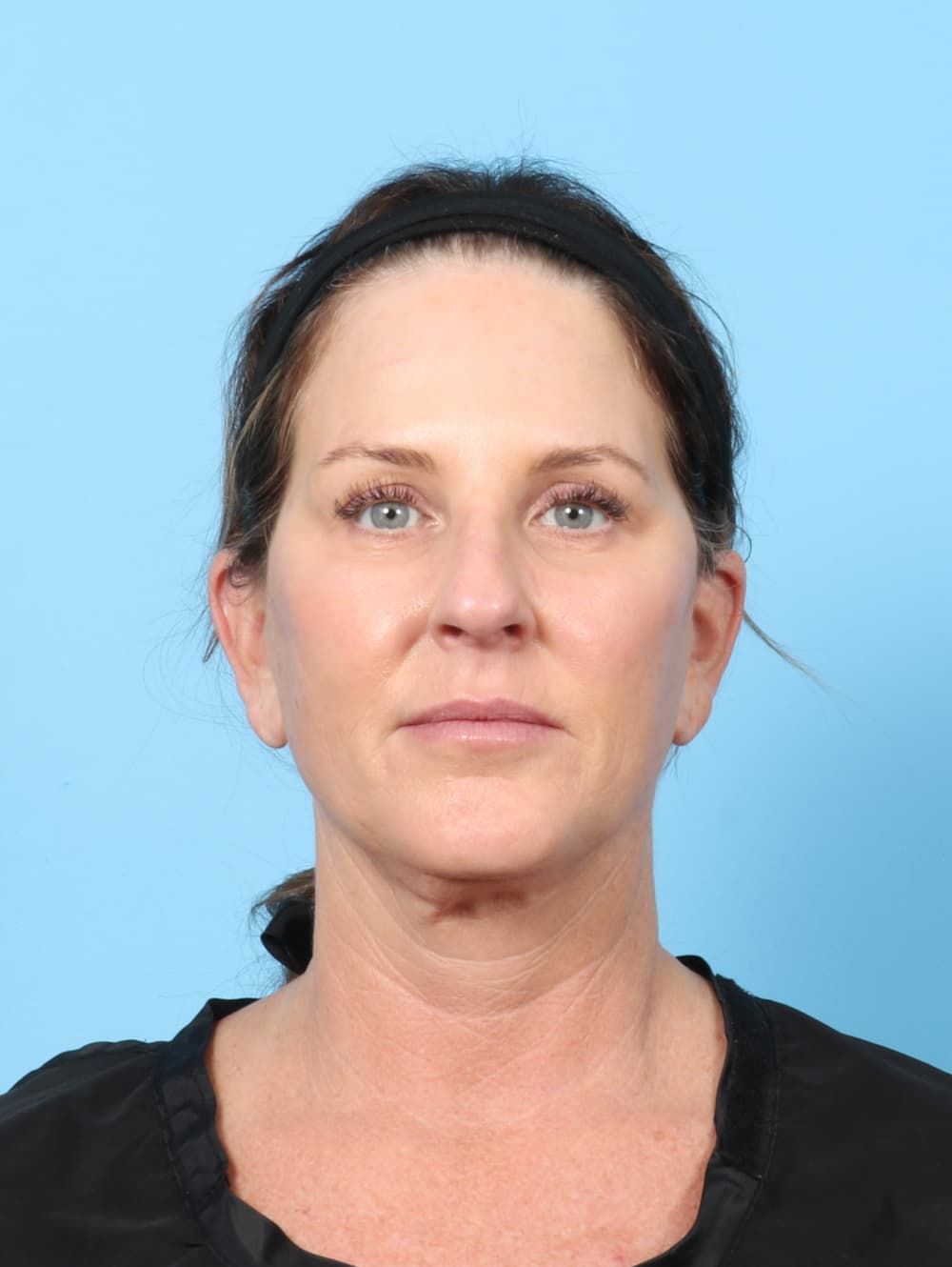 Facelift case #7622 after