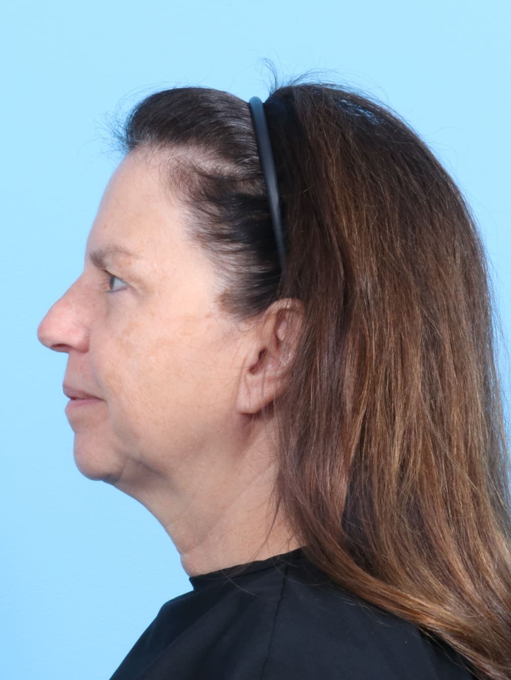 Facelift case #2266 before, image 3