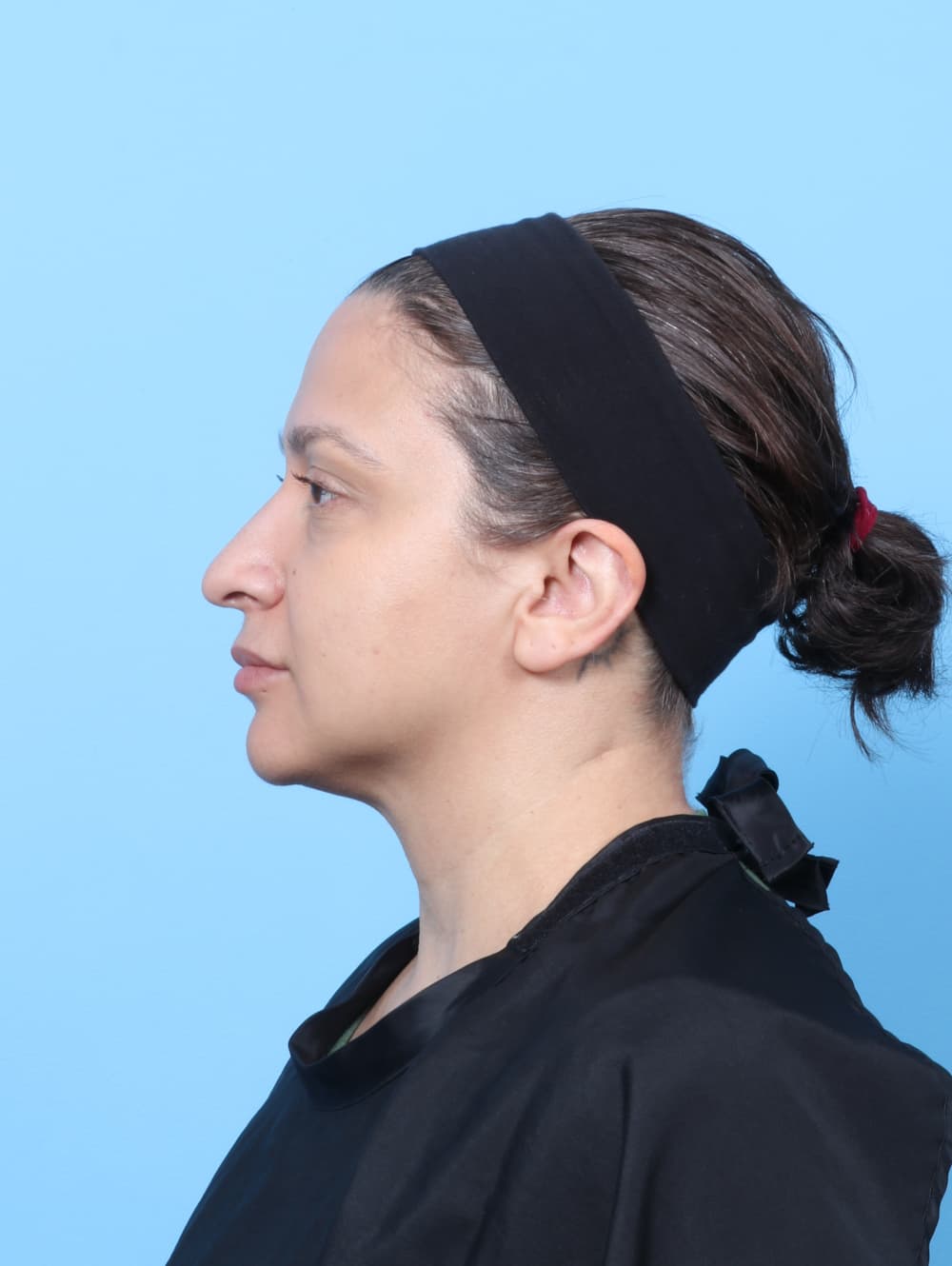 Rhinoplasty case #9034 before, image 1