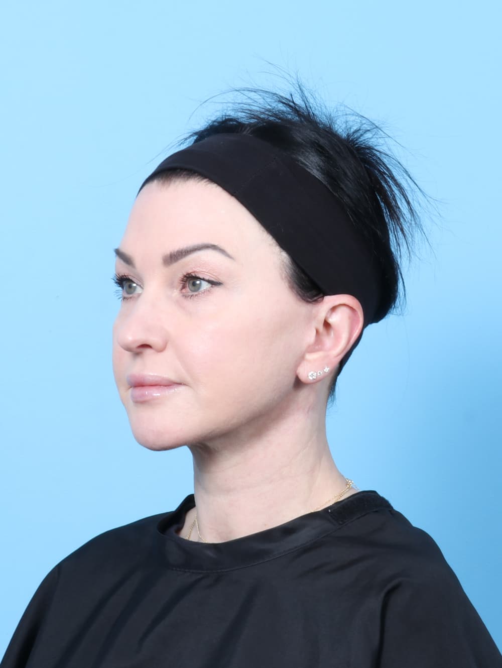 Facelift case #9004 after, image 3