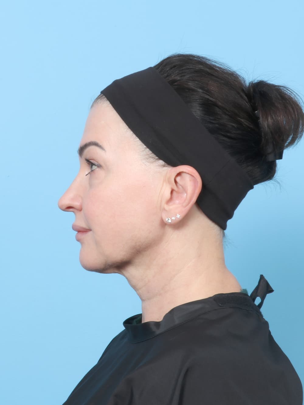 Facelift case #9004 before, image 4