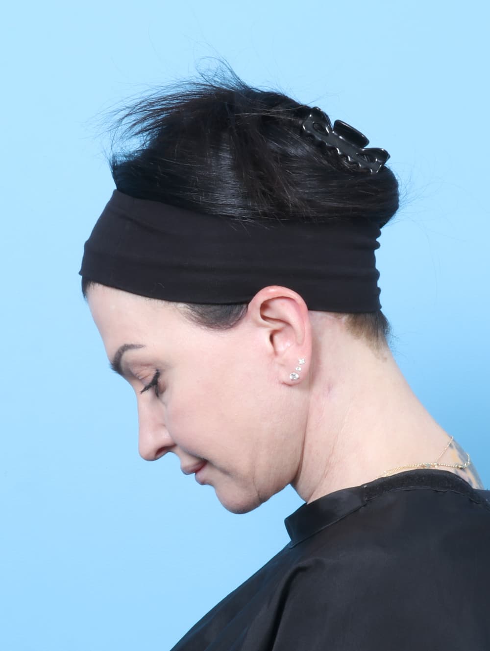 Facelift case #9004 after, image 2