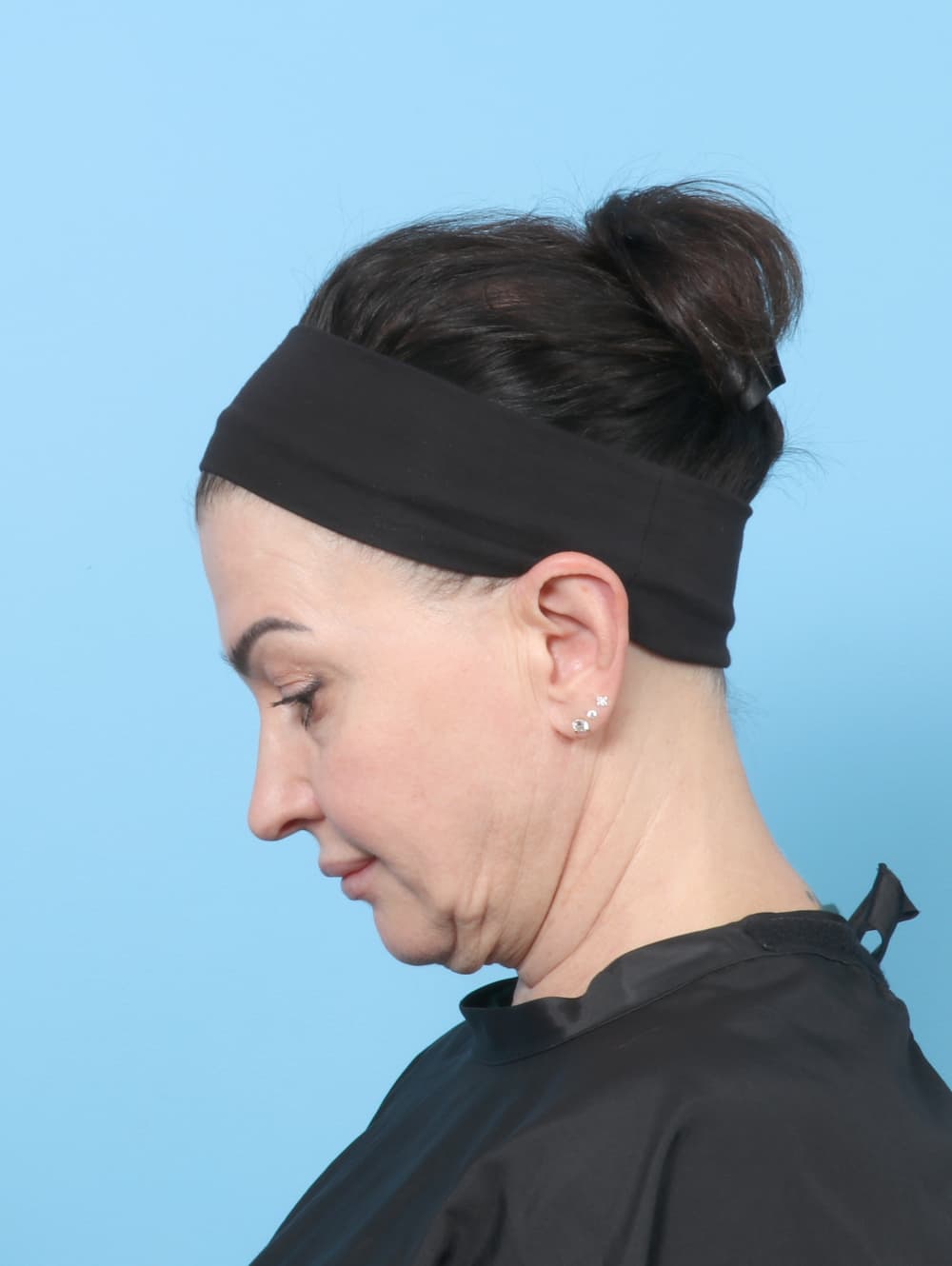 Facelift case #9004 before, image 2