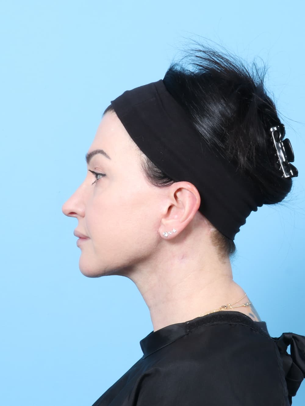Facelift case #9004 after, image 4