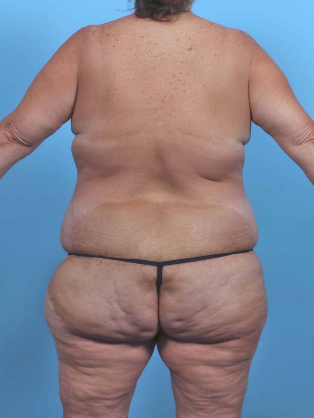 Breast Lift/Reduction case #5694 after, image 2