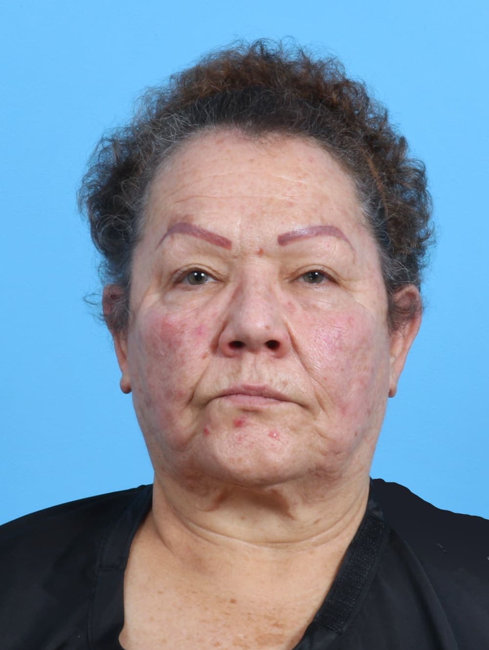 Facelift case #3898 before