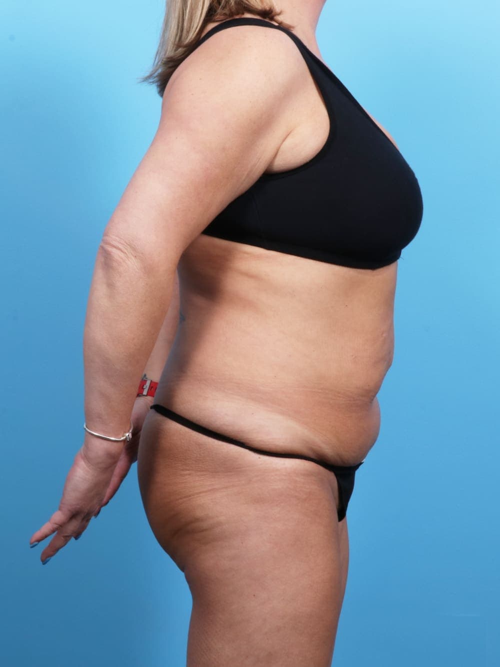 Tummy Tuck case #1722 before, image 3