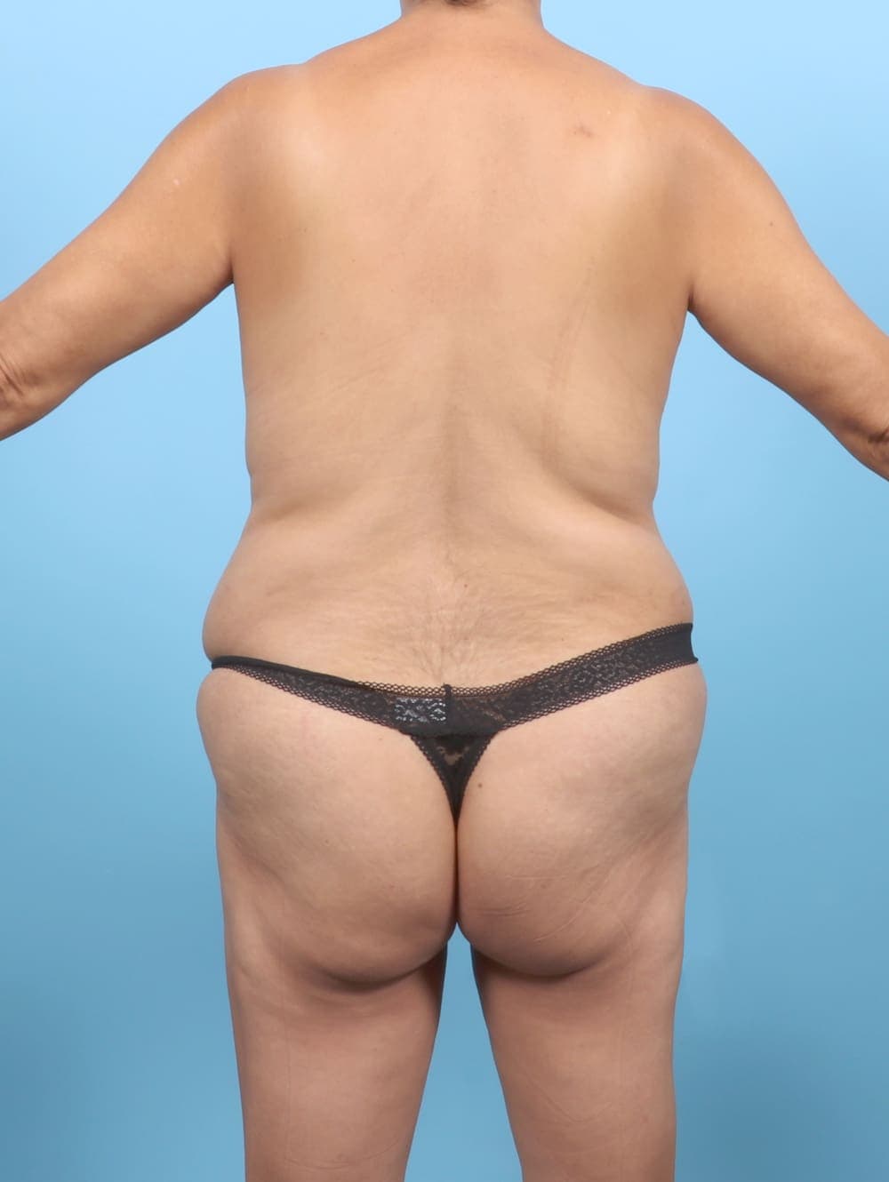Tummy Tuck case #6651 before, image 4