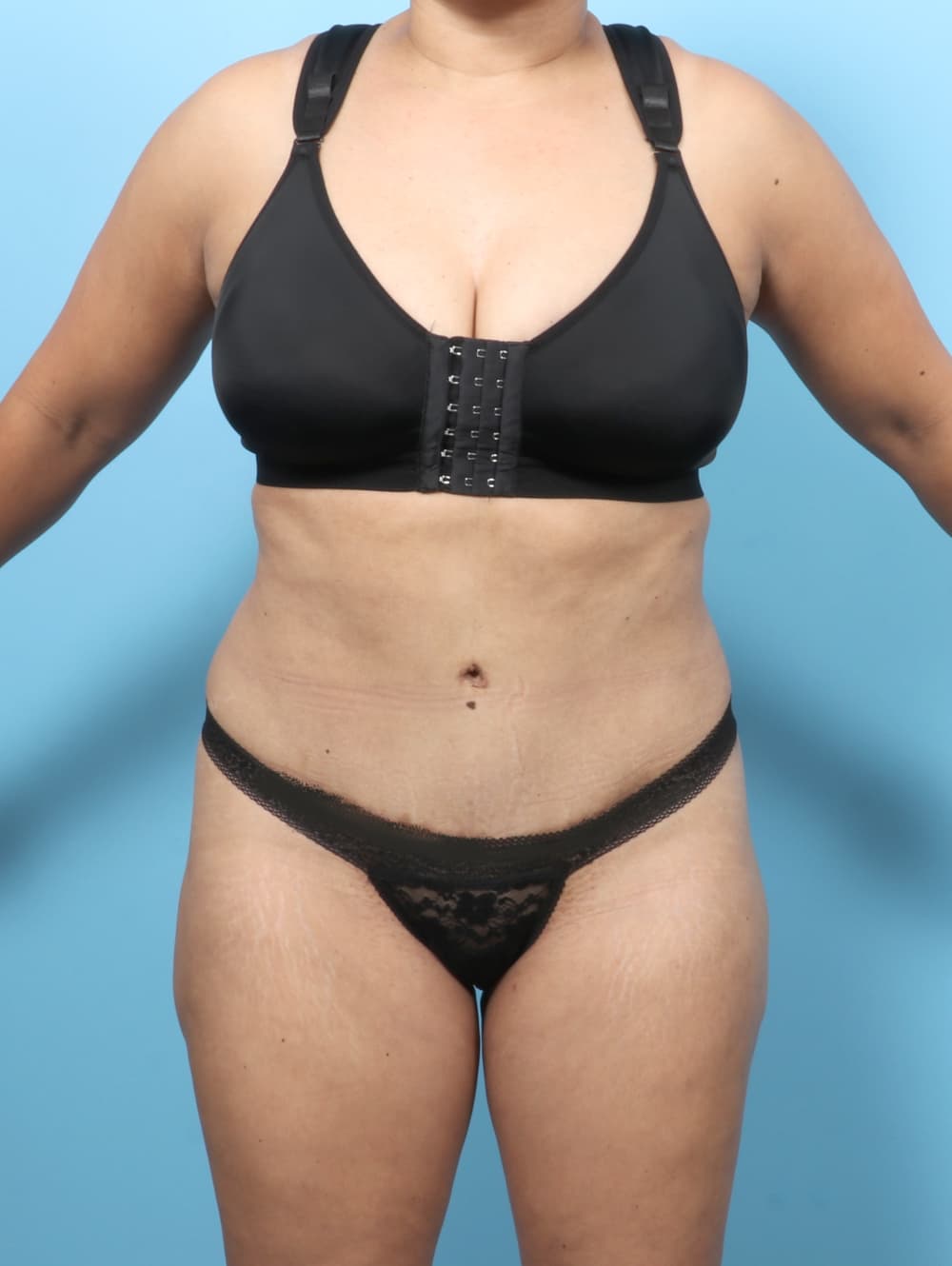Liposuction case #7574 after, image 1