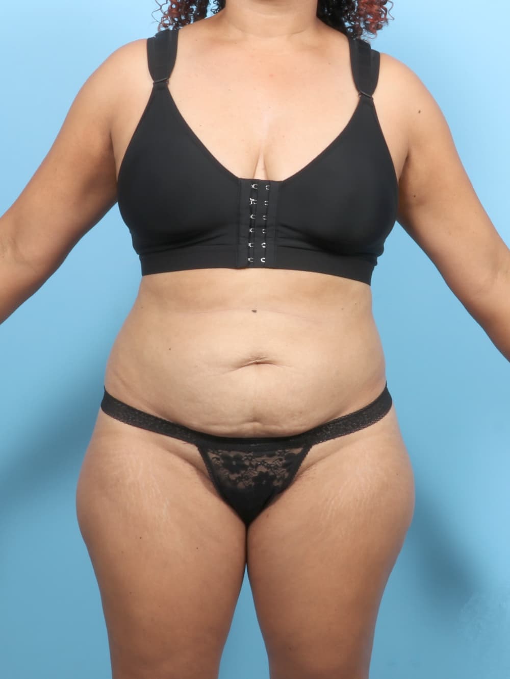 Liposuction case #7574 before, image 1