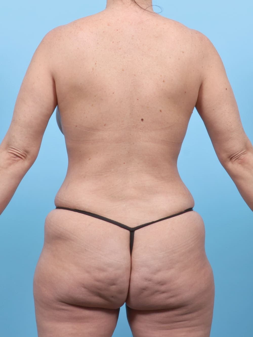 Liposuction case #6555 after, image 2