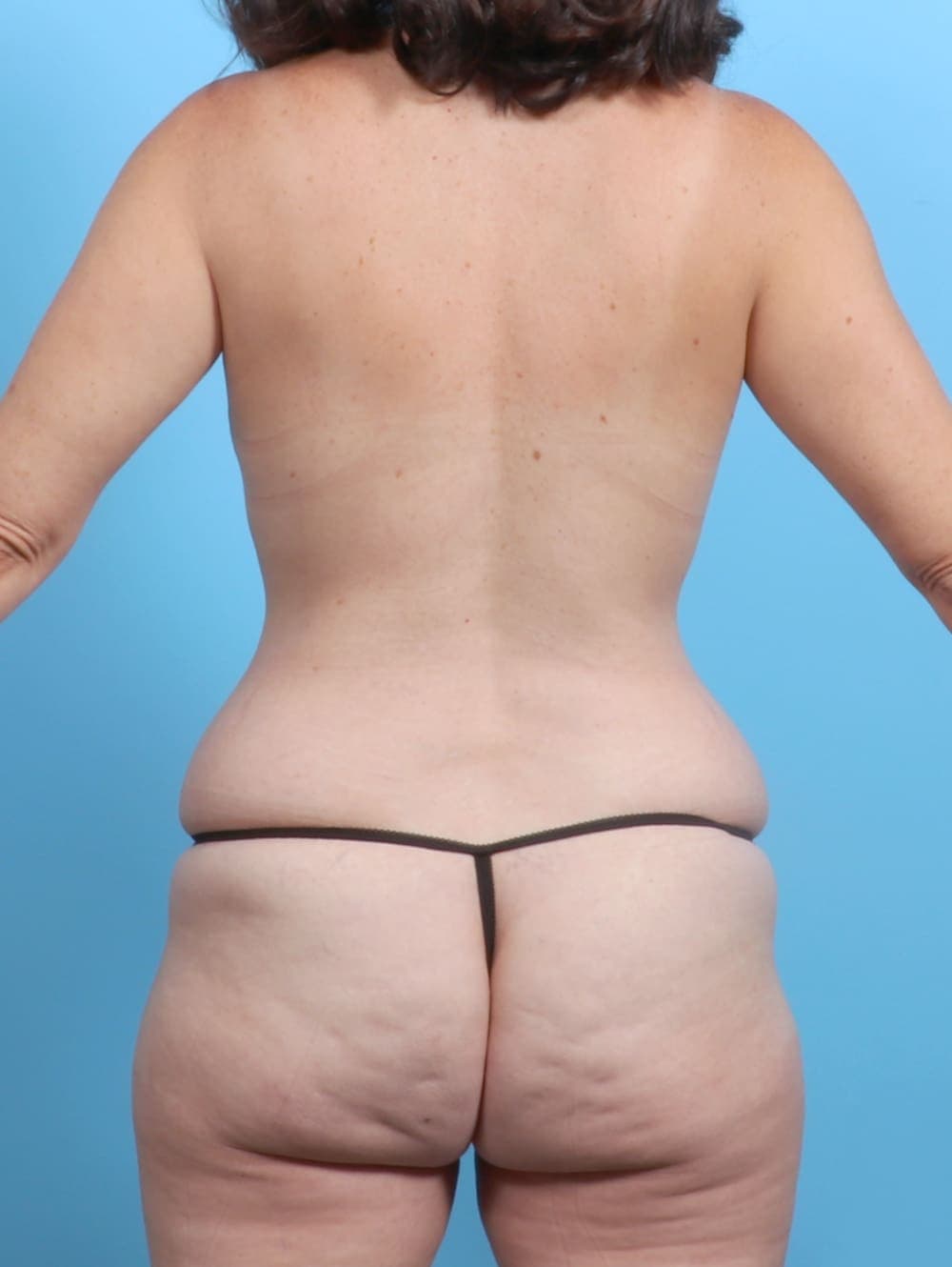 Liposuction case #6555 before, image 2