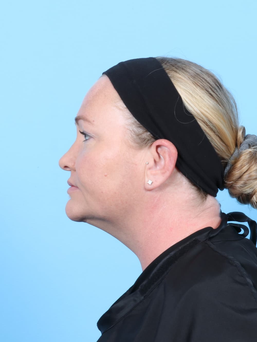 Facial Liposuction case #6998 after, image 3