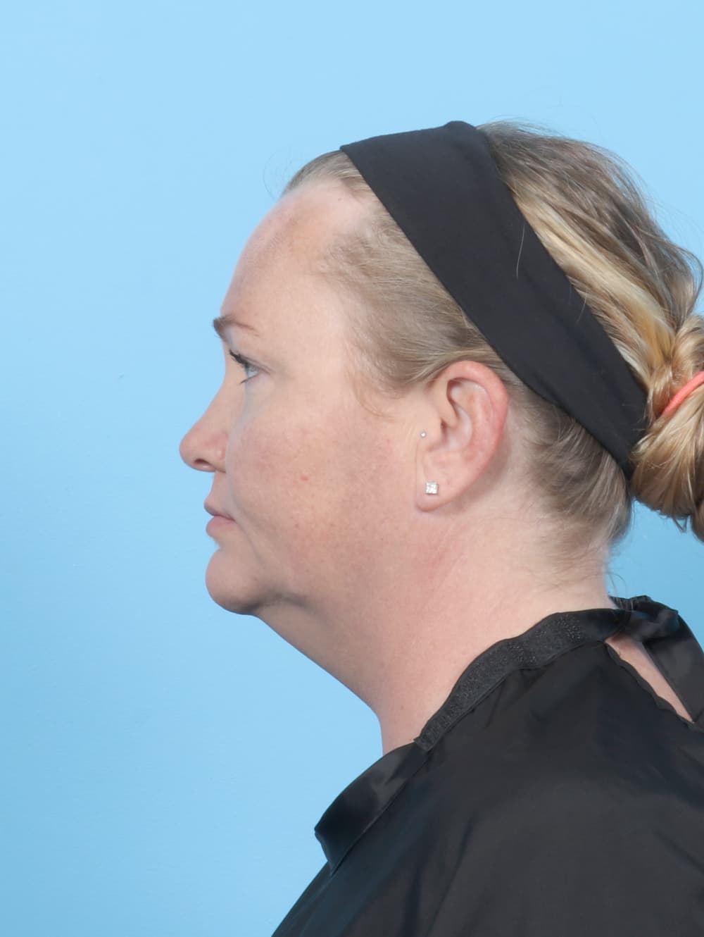 Facial Liposuction case #6998 before, image 3