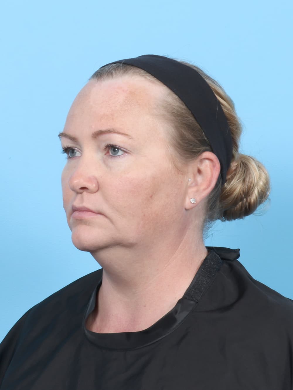 Facial Liposuction case #6998 before, image 2